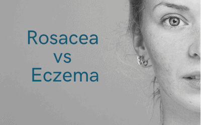 Rosacea vs Eczema: Knowing the Difference and Finding A Treatment