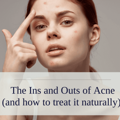 The Ins and Outs of Acne (and how to treat it naturally!)
