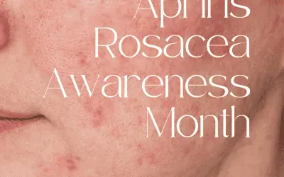 Getting to Grips with Rosacea: Symptoms, Triggers and What to Do