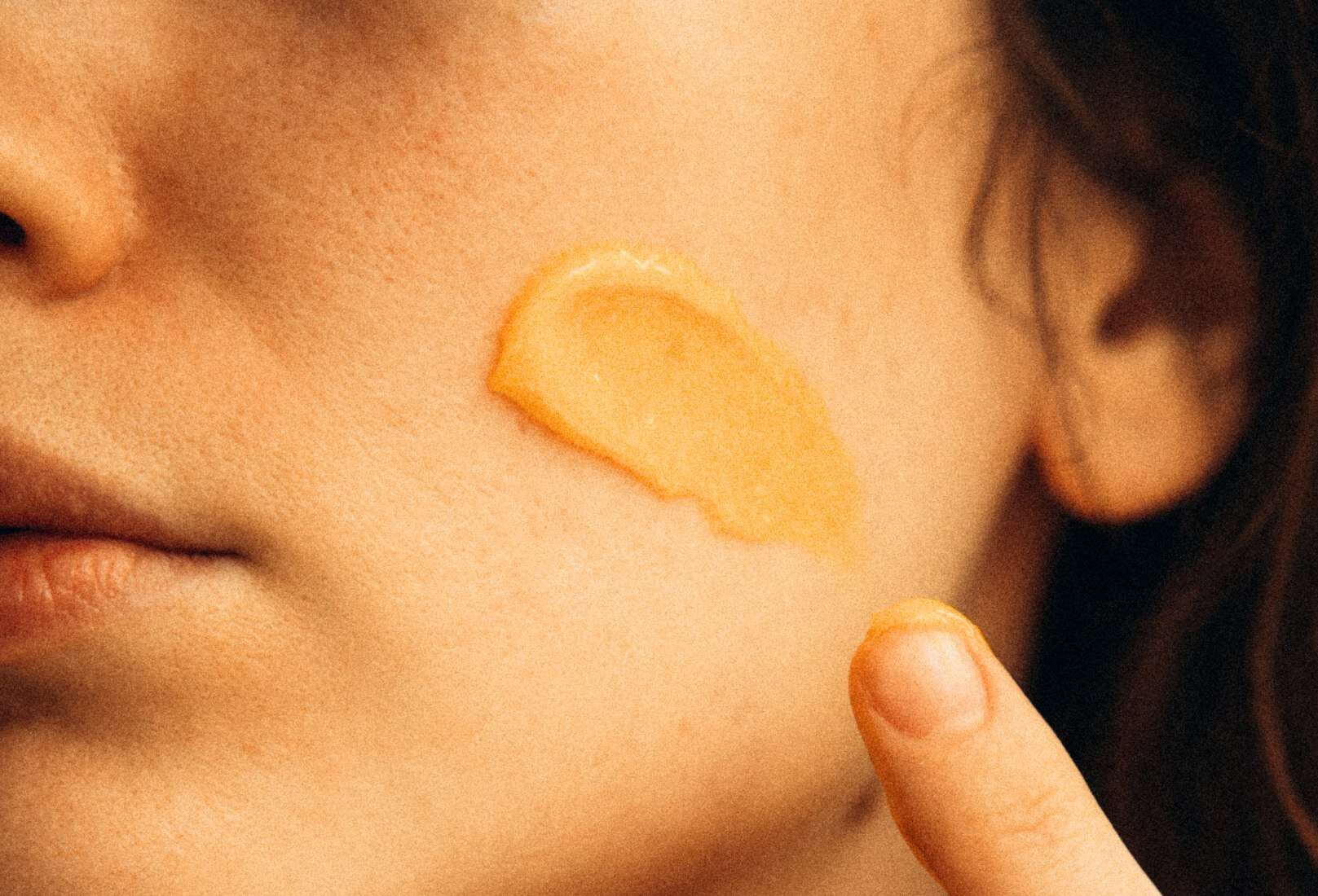 Rosacea Awareness, Why It’s More Than Just Redness.